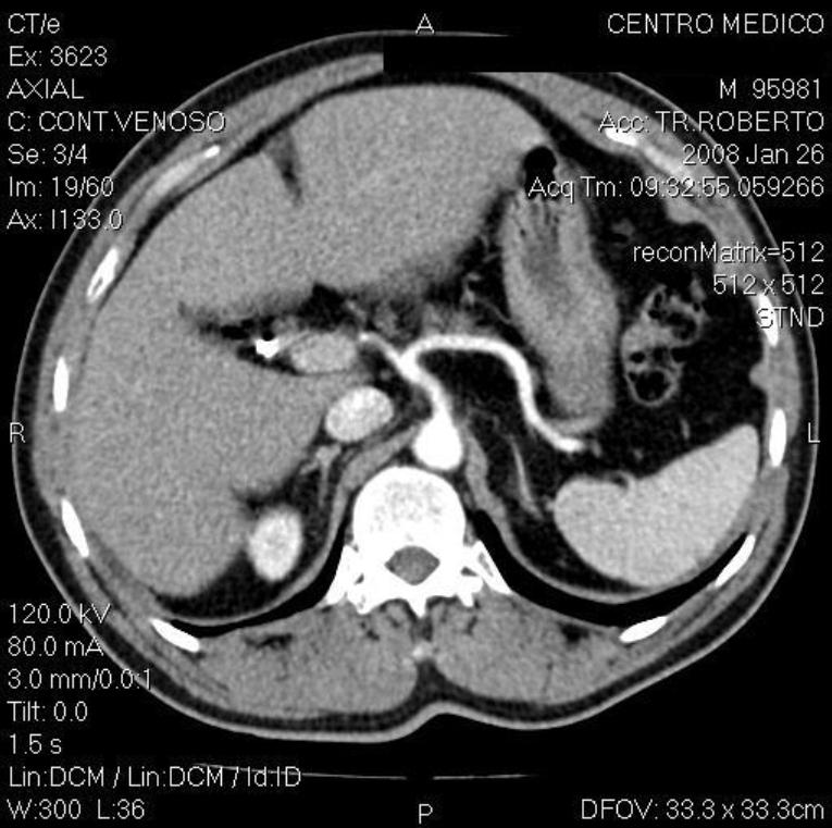 Figure 1 - Computed tomography of the adrenal glands of patient with a diagnosis of primary hyperaldosteronism. patient s treatment was started with spironolactone (25 mg/day).