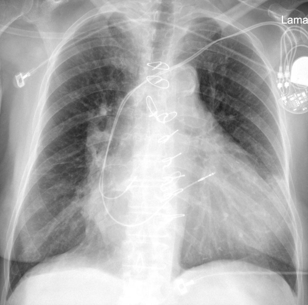 Chest Radiology: A Resident`s Manual J.