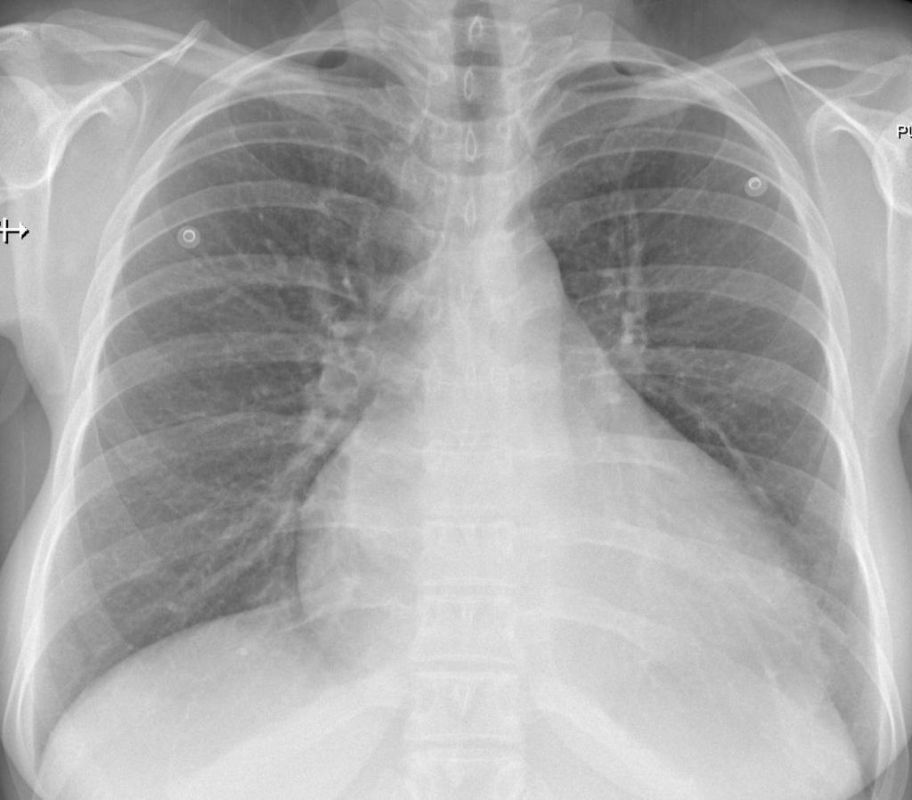 Bifurcation on Chest Radiographs: Value as a Sign