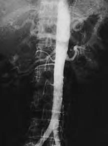 For this test, your healthcare provider moves a sensor across your abdomen. CT (computed tomography). A series of x-rays are taken with a special x-ray machine.