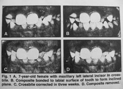 Composite bonding Convenient - bond composite to the labial surface of the maxillary