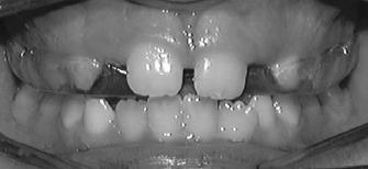 treatment Acrylic palatal coverage and wire clasps The auxilliary or finger springs
