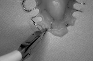 slow-lightcontinuous forces Fixed appliance Light arch wire combined with maxillary lingual arch with auxilliary springs Indicated for a very young child