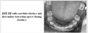 the crossbite problem Overcorrect and leave the bands in place right after active treatment In case