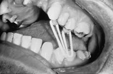 Crossbite Elastics Selective grinding of teeth Elastics Palatal expansion Fixed rapid palatal