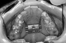 slight maxillary constriction due to primary canine interferences Functional shift of the mandible