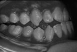 antagonistic tooth or