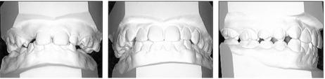 mandibular affected tooth