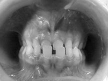 Centric Occlusion (CO) Mandibular position dictated by maximum and habitual intercuspation of