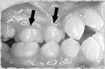 Pseudo-Class III A pseudo-class III due to a deficient maxilla in concert with a constriction