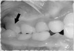 single tooth Either of dental or skeletal origin Pseudo-Class vs.