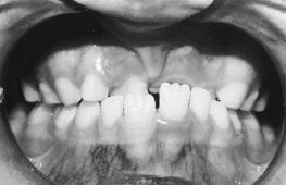Skeletal Crossbite A malocclusion with maxillary posterior teeth occluding lingual to the mandibular due to malposition of the
