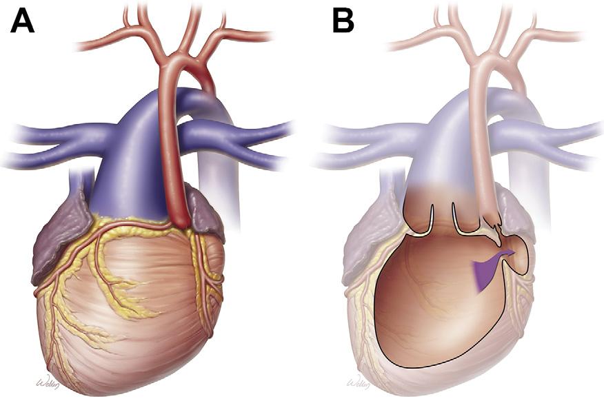 Ann Thorac Surg HEINLE ET AL 2013;95:212 9 PALLIATIVE ARTERIAL SWITCH OPERATION 213 Fig 1. Double-inlet left ventricle with transposed great arteries and hypoplastic subaortic outflow chamber.