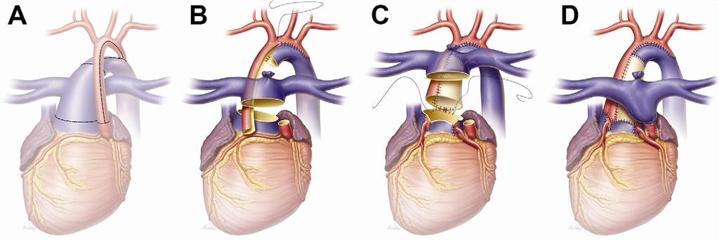 214 HEINLE ET AL Ann Thorac Surg PALLIATIVE ARTERIAL SWITCH OPERATION 2013;95:212 9 Fig 2. Palliative arterial switch operation. (A) Transection of ascending aorta and main pulmonary artery.