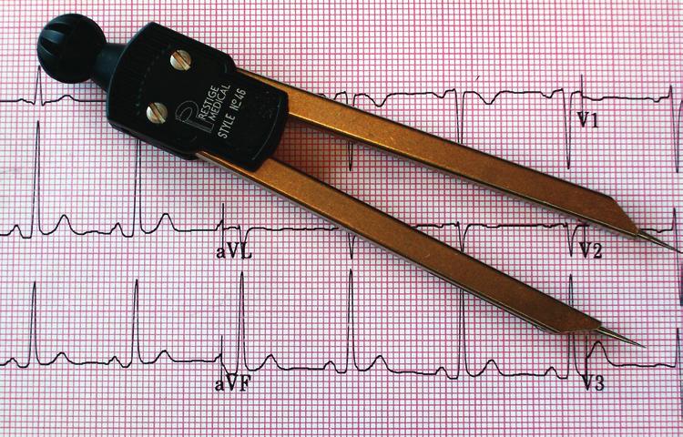 Figure 5-1 Calipers are used to measure ECG tracing. example, it is often easier to see the R wave of the QRS complex.