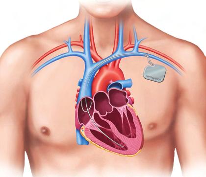 Figure 5-32 Implanted pacemaker.