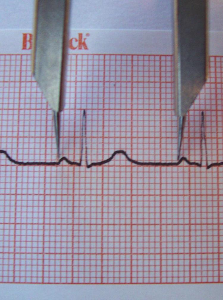 Figure 5-2 Measuring the P-to-P wave interval. divide the number into 1500 to calculate the heart rate.