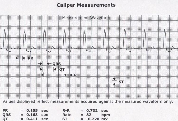 Figure 5-3 Computerized caliper measurement of the R-to-R wave interval.