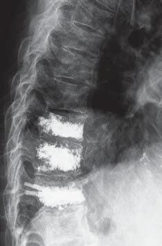 pathological fractures at the T9 and T7 vertebrae. Fig 5 Sagittal view of the spine following kyphoplasty of T9 and T7 with cement augmentation of T8.