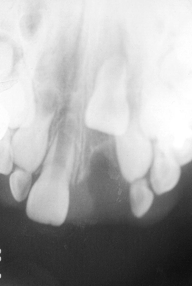 However, clinical and radiographic examination revealed that left maxillary central incisor was intrusively luxated with cortical bone fracture (Figures 1 to 3).