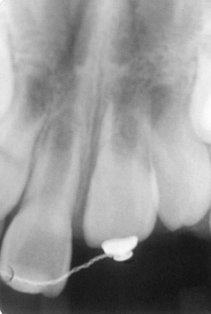 Endodontic treatment was postponed, as there were no discernable signs of