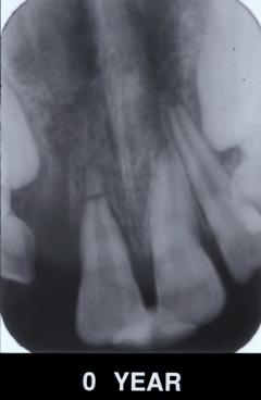 tooth May require extraction of coronal