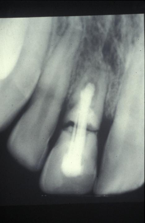 Problems with apexification Risk of root fracture in immature teeth treated with apexification ücvek 1992. Endodontics and Dental Traumatology 8, 45 55.
