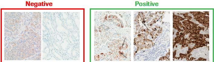 Ventana ALK (D5F3) CDx Assay 1 Ventana ALK (D5F3) CDx Assay is intended for the qualitative detection of the ALK protein in FFPE NSCLC tissue stained with a BenchMark XT automated staining instrument