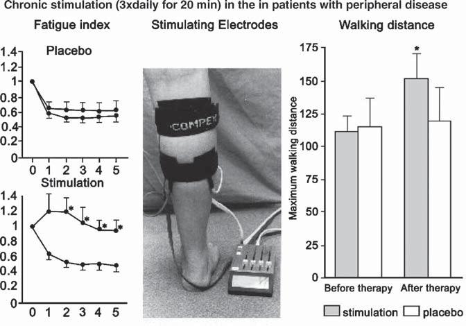 2 Cardiovascular System 45 Fig. 2.12 Treatment of patients with peripheral vascular disease by electrical stimulation.