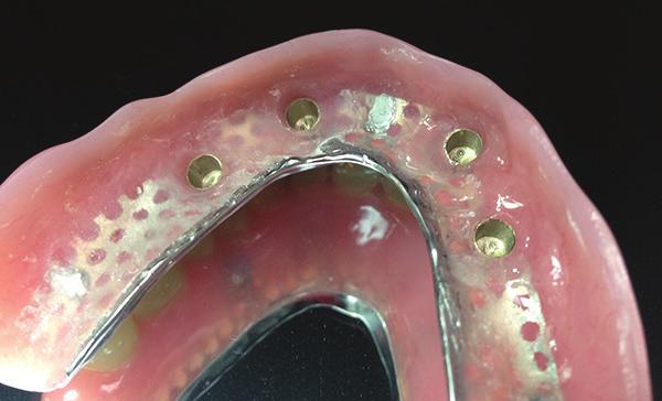 We keep a digital record of the model with Conus abutments, opposing model and bite