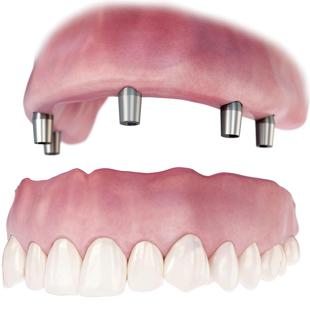 Conus is a cost effective, friction retained denture, supported by patient-specific abutments.