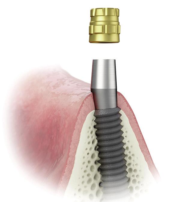 The system is processed directly into the implant and is available for most major implant systems.