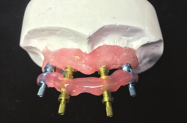 It is important to take this impression using a custom tray, paying special attention to accurate indexing of the vestibule and palatal areas.