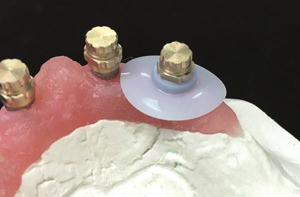 Fourth Appointment CLINICAL STEPS Transfer the Conus abutments to the mouth using the positioning indicators Press the SynCone caps onto the Conus abutments using finger pressure