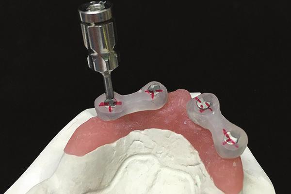 Transfer the Conus abutments directly from the model to the mouth using the positioning indicators.