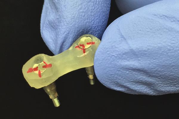 Unscrew the abutments from the model through the positioning indicators and transfer to the mouth without removing the abutments from the positioning indicators.