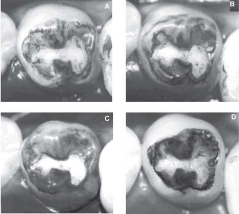 LONGITUDINAL PHOTOGRAPHIC OBSERVATION OF THE OCCURRENCE OF BUBBLES IN PIT AND FISSURE SEALANTS was placed only inside the cavity without excess material. Similarly, Conry, et al.