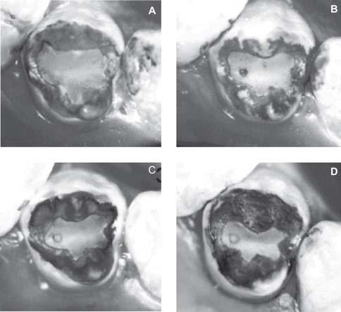 at the central area of the fissure or on the cavity restored with composite resin.
