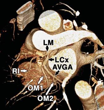 Fig. 17 Dominant left circumflex artery anatomy in 44-year-old man.
