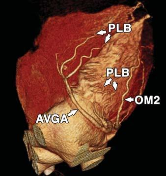 posterior descending artery, PL = posterior lateral branch, RI = ramus intermedius artery.