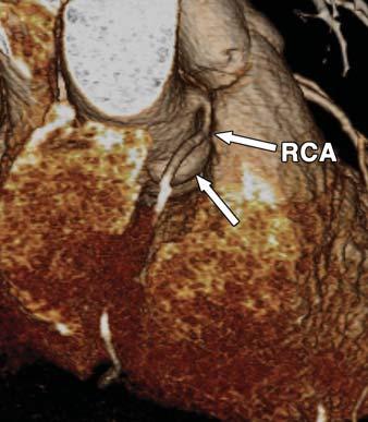 o = aortic root, LD = left anterior descending artery, LM = left main coronary artery, RC = right coronary artery, RVOT = right ventricular outflow tract.