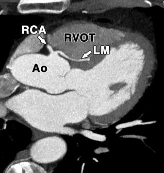 subsequent acute rightward course before reaching anterior atrioventricular groove.