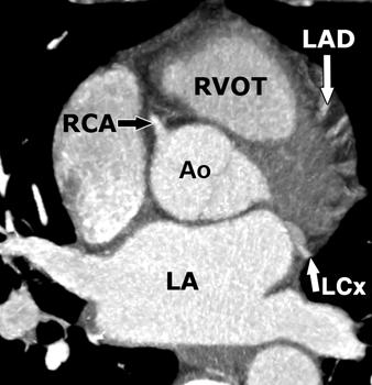 = left main coronary artery, LV = left ventricle, PD = posterior descending artery, R = right atrium, RC = right coronary