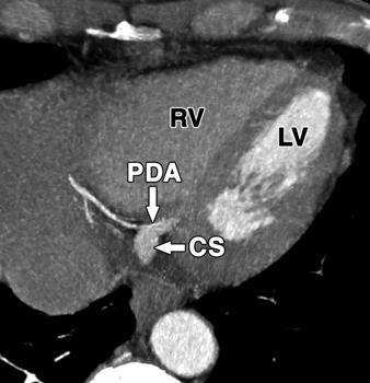 main coronary artery. C, xial 5-mm MIP image shows course of right coronary artery within anterior atrioventricular groove.