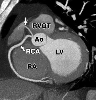 right coronary artery, RVOT = right ventricular outflow tract, SN = sinoatrial node branch.