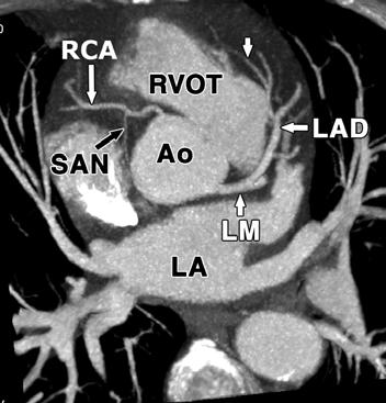 C, xial 10-mm MIP image shows conus branch (arrow) arising from proximal RC in 52-year-old man.