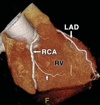 woman., Right anterior oblique volume-rendered image shows marginal branch (arrow) of RC as it courses over right ventricle in 45-year-old woman. Fig.