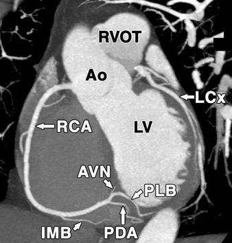 Distally, posterior descending artery and posterior lateral branch are shown, as is atrioventricular node branch.