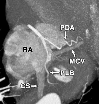 posterior lateral branch, RC = right coronary artery, RVOT = right ventricular outflow tract. C Fig.