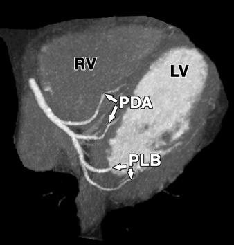 CS = coronary sinus, LV = left ventricle, MCV = middle cardiac vein, PD = posterior descending artery, PL = posterior lateral branch, PLV = posterolateral vein, R =